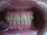 /album/fotogaleria-inicio/blanqueamiento-antes-jpg/
